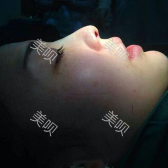 硅膠假體隆鼻后恢復(fù)得很漂亮下一步的目標是自體脂肪全臉填充