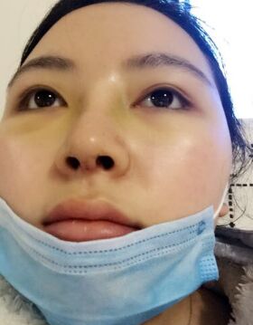 天津美萊吳勝做的硅膠假體隆鼻還墊鼻尖了