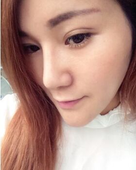 鼻頭巨大做了鼻翼縮小術(shù)后秀氣了不少