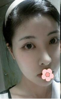 做了磨顴骨手術的我從小鴨子變成白天鵝 謝謝柳大烈教授