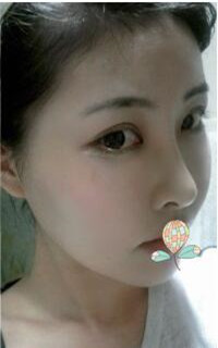 做了磨顴骨手術的我從小鴨子變成白天鵝 謝謝柳大烈教授