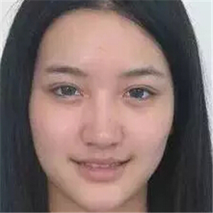 去年做的注射B****微整形，你們看看恢復前后的對比照片~~~