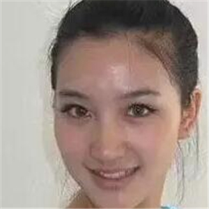 去年做的注射B****微整形，你們看看恢復前后的對比照片~~~