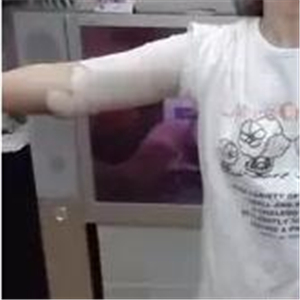 手臂吸脂手術(shù)八個月了，看看我的前后對比果圖片吧~~