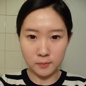 看我自體軟骨墊鼻尖恢復過程的照片，前后對比差別有點大呢~