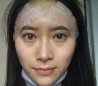 大腿吸脂做自體脂肪面部填充三個月了，分享給大家