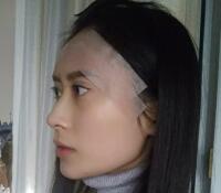 大腿吸脂做自體脂肪面部填充三個月了，分享給大家