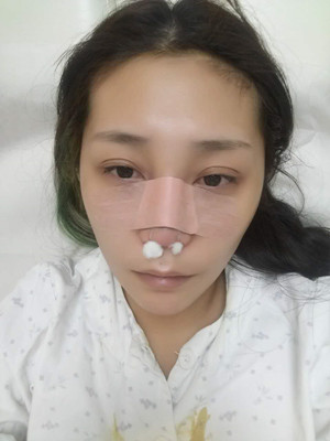 周長(zhǎng)兵給我做的隆鼻整形恢復(fù)得好自然