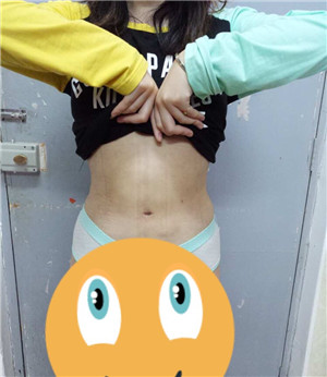 周長(zhǎng)兵做的水動(dòng)力吸脂瘦腰腹 大肚腩沒(méi)有了