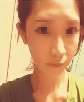 【20天康復記錄】隆鼻+面部脂肪填充，遇見更美的自己