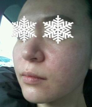 光子嫩膚后，整個(gè)人漂亮多了