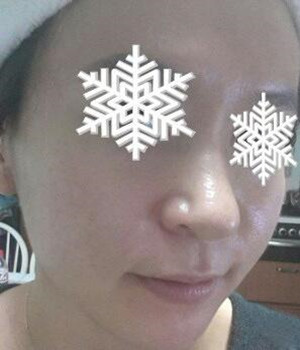 光子嫩膚后，整個(gè)人漂亮多了