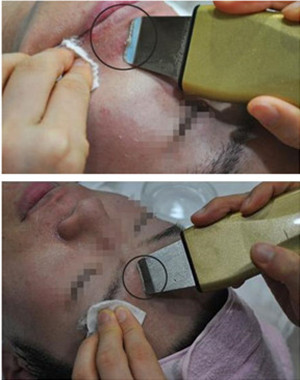 激光祛痘果怎么樣？激光祛痘前后過(guò)程對(duì)比圖