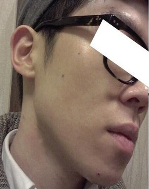 激光祛痘果怎么樣？激光祛痘前后過(guò)程對(duì)比圖