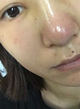 硅膠假體隆鼻給我?guī)沓每吹谋亲? /> </a>
										<a href=