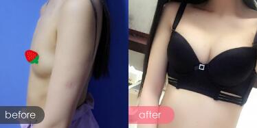 假體隆胸，假體隆胸價格為28000元