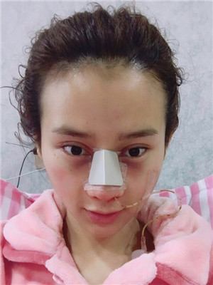 吳建明教授做的隆鼻整形 看起來(lái)還不錯(cuò)