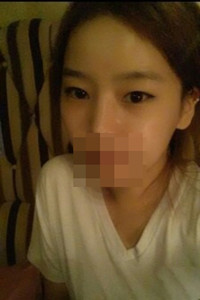 膨體隆鼻手術(shù)前后對(duì)比照片，真實(shí)案例分享！