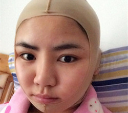 下頜角+顴骨手術(shù)前后過程以及真實(shí)果對(duì)比圖