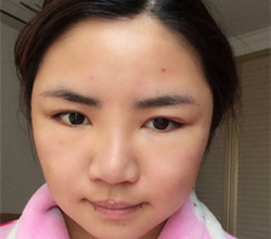 下頜角+顴骨手術(shù)前后過程以及真實(shí)果對(duì)比圖