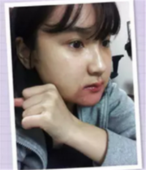 做了磨下頜角整形手術(shù)4個月了，曬曬我的恢復(fù)前后的對比照片吧~~