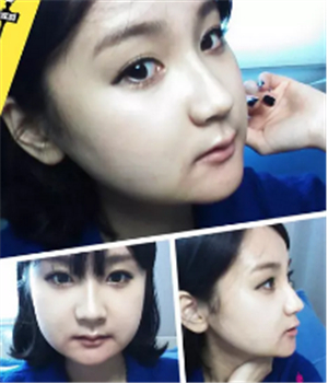 做了磨下頜角整形手術(shù)4個月了，曬曬我的恢復(fù)前后的對比照片吧~~