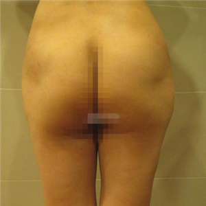 做了自體脂肪移植豐胸手術，勾勒出**胸部曲線，看看果照片~~