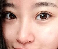 內(nèi)切去眼袋價(jià)格2180元，祛眼袋前后對(duì)比圖分享給大家