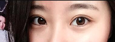 祛眼袋手術(shù)價(jià)格分享