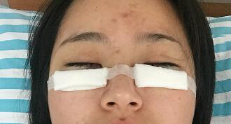 祛眼袋手術(shù)圖，恢復(fù)過程