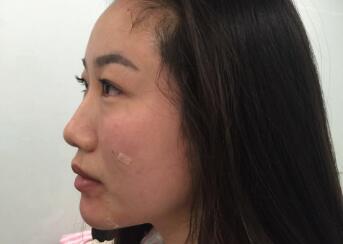 大腿的脂肪做填充自體脂肪后的圖片