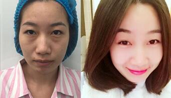 自體脂肪面部填充前后對比圖