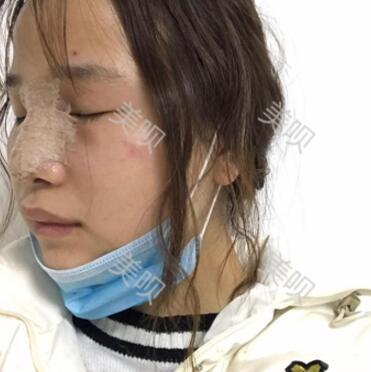 在蘇州常春藤做的硅膠假體隆鼻為大家分享下我的恢復(fù)全過程吧