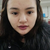 玻尿酸隆鼻花了兩萬(wàn)多果很自然哦，值~！