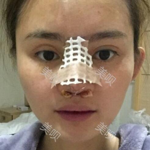 玻尿酸隆鼻花了兩萬(wàn)多果很自然哦，值~！