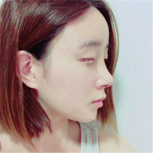 蔣醫(yī)生做的隆鼻失敗修復分享，還有前后對比果圖片哦~