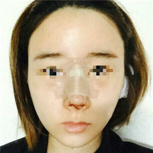 蔣醫(yī)生做的隆鼻失敗修復分享，還有前后對比果圖片哦~