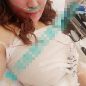 分享我自體脂肪隆胸手術(shù)前后對比照片，果不錯哦~