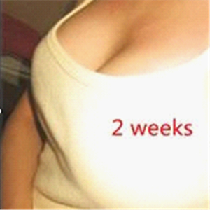 分享我自體脂肪隆胸手術(shù)前后對比照片，果不錯哦~