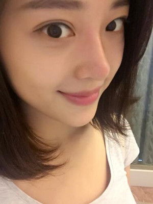 翟爽給我打玻尿酸隆鼻做出了假體的感覺