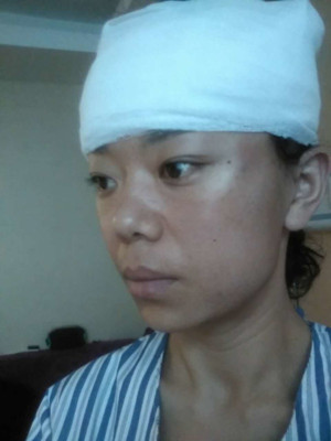 電波l皮緊膚手術(shù)過程及前后對比照片