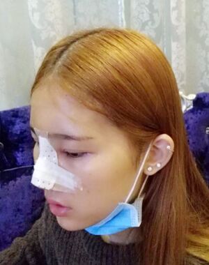 隆鼻整形果好到無法形容，廣州海峽軍做的