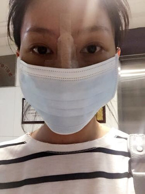 隆鼻手術(shù)前后過(guò)程對(duì)比圖，真實(shí)案例分享