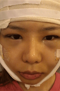 磨骨+下巴矯正手術(shù)前后過(guò)程(膽小勿入!)真實(shí)案例分享