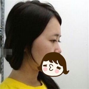 去年做的自體脂肪隆鼻手術(shù)，曬一下前后對比果圖片~