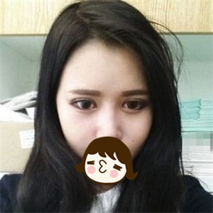 去年做的自體脂肪隆鼻手術(shù)，曬一下前后對比果圖片~