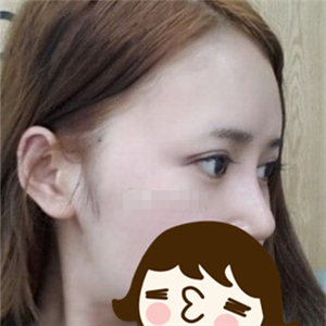 去年做的自體脂肪隆鼻手術(shù)，曬一下前后對比果圖片~