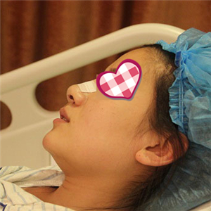 分享我自體軟骨隆鼻前后對比果圖片和恢復(fù)過程，在愛斯克做的哦~