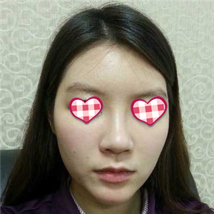 分享我自體軟骨隆鼻前后對比果圖片和恢復(fù)過程，在愛斯克做的哦~