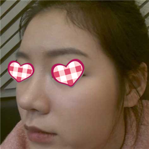 分享我自體軟骨隆鼻前后對比果圖片和恢復(fù)過程，在愛斯克做的哦~